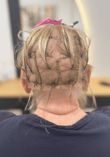 Mesh Integration hair replacement system applied to woman facing hair loss from alopecia